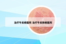 治療牛皮癬醫(yī)院 治療牛皮膚癬醫(yī)院