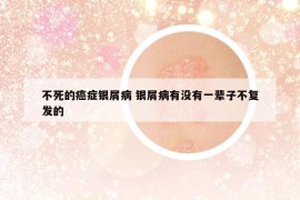 不死的癌癥銀屑病 銀屑病有沒有一輩子不復(fù)發(fā)的