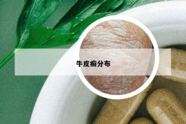 牛皮癬分布