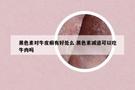 黑色素對牛皮癬有好處么 黑色素減退可以吃牛肉嗎
