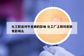 化工職業(yè)對牛皮癬的影響 化工廠上班對皮膚有影響么