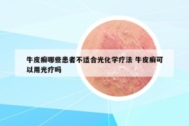 牛皮癬哪些患者不適合光化學(xué)療法 牛皮癬可以用光療嗎
