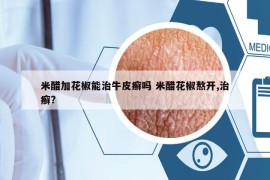 米醋加花椒能治牛皮癬嗎 米醋花椒熬開,治癬?
