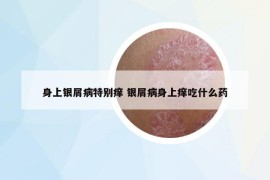 身上銀屑病特別癢 銀屑病身上癢吃什么藥