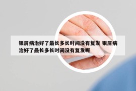 銀屑病治好了最長多長時間沒有復發(fā) 銀屑病治好了最長多長時間沒有復發(fā)呢