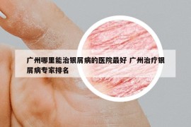 廣州哪里能治銀屑病的醫(yī)院最好 廣州治療銀屑病專家排名