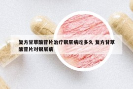 復(fù)方甘草酸苷片治療銀屑病吃多久 復(fù)方甘草酸苷片對(duì)銀屑病