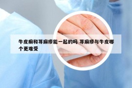 牛皮癬和蕁麻疹能一起的嗎 蕁麻疹與牛皮哪個(gè)更難受