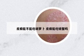皮癬能不能吃胡蘿卜 皮癬能吃螃蟹嗎