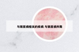 與銀屑病相關(guān)的疾病 與銀屑病共舞