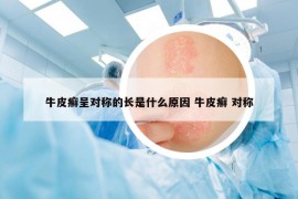 牛皮癬呈對(duì)稱的長(zhǎng)是什么原因 牛皮癬 對(duì)稱