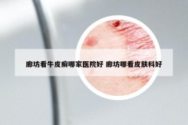 廊坊看牛皮癬哪家醫(yī)院好 廊坊哪看皮膚科好