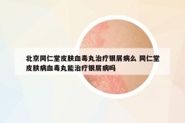 北京同仁堂皮膚血毒丸治療銀屑病么 同仁堂皮膚病血毒丸能治療銀屑病嗎
