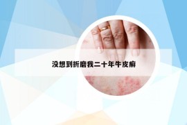 沒想到折磨我二十年牛皮癬