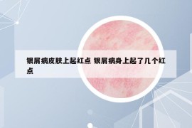 銀屑病皮膚上起紅點 銀屑病身上起了幾個紅點