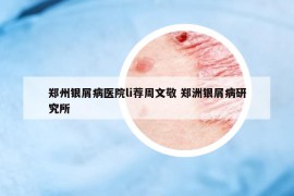 鄭州銀屑病醫(yī)院li薦周文敬 鄭洲銀屑病研究所