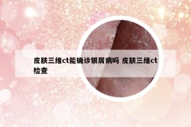 皮膚三維ct能確診銀屑病嗎 皮膚三維ct檢查