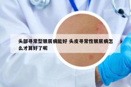頭部尋常型銀屑病能好 頭皮尋常性銀屑病怎么才算好了呢