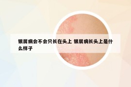 銀屑病會不會只長在頭上 銀屑病長頭上是什么樣子