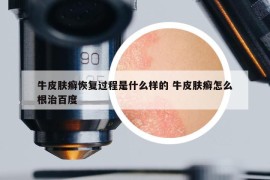 牛皮膚癬恢復(fù)過程是什么樣的 牛皮膚癬怎么根治百度