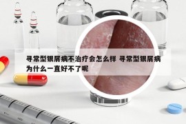 尋常型銀屑病不治療會怎么樣 尋常型銀屑病為什么一直好不了呢