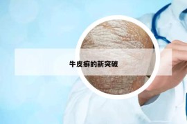 牛皮癬的新突破