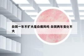 白斑一年不擴大是白癜風(fēng)嗎 白斑兩年變化不大
