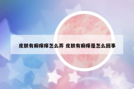 皮膚有癬癢癢怎么弄 皮膚有癬癢是怎么回事