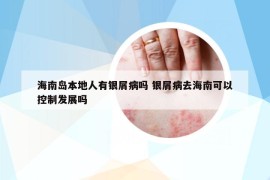 海南島本地人有銀屑病嗎 銀屑病去海南可以控制發(fā)展嗎
