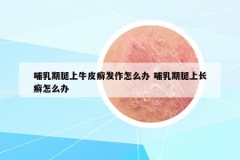 哺乳期腿上牛皮癬發(fā)作怎么辦 哺乳期腿上長(zhǎng)癬怎么辦