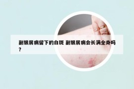 副銀屑病留下的白斑 副銀屑病會長滿全身嗎?
