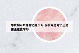 牛皮癬可以搽金達(dá)克寧嗎 皮癬用達(dá)克寧還是用金達(dá)克寧好