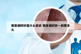 銀屑病轉(zhuǎn)好是什么癥狀 銀屑病好轉(zhuǎn)一般要多久