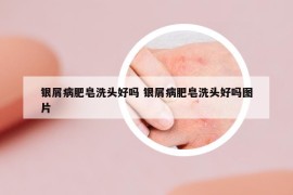 銀屑病肥皂洗頭好嗎 銀屑病肥皂洗頭好嗎圖片