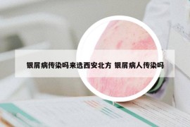 銀屑病傳染嗎來選西安北方 銀屑病人傳染嗎