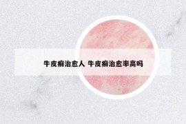 牛皮癬治愈人 牛皮癬治愈率高嗎