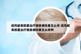 疏風(fēng)解毒膠囊治療銀屑病效果怎么樣 疏風(fēng)解毒膠囊治療銀屑病效果怎么樣啊