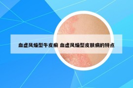 血虛風(fēng)燥型牛皮癬 血虛風(fēng)燥型皮膚病的特點(diǎn)
