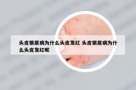 頭皮銀屑病為什么頭皮發(fā)紅 頭皮銀屑病為什么頭皮發(fā)紅呢