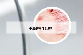 牛皮癬喝什么茶葉