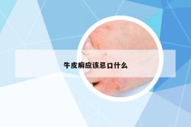 牛皮癬應該忌口什么
