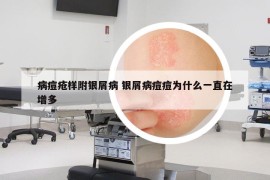病痘瘡樣附銀屑病 銀屑病痘痘為什么一直在增多