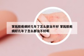 掌跖膿皰病好幾年了怎么都治不好 掌跖膿皰病好幾年了怎么都治不好呢