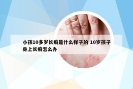 小孩10多歲長(zhǎng)癬是什么樣子的 10歲孩子身上長(zhǎng)癬怎么辦