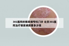 301醫(yī)院的銀屑病專科門診 北京301醫(yī)院治療銀屑病需要多少錢