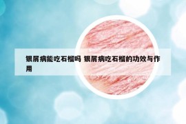 銀屑病能吃石榴嗎 銀屑病吃石榴的功效與作用