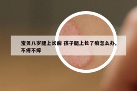 寶貝八歲腿上長癬 孩子腿上長了癬怎么辦,不疼不癢