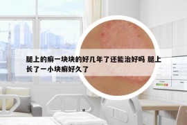 腿上的癬一塊塊的好幾年了還能治好嗎 腿上長(zhǎng)了一小塊癬好久了