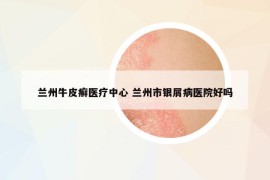 蘭州牛皮癬醫(yī)療中心 蘭州市銀屑病醫(yī)院好嗎