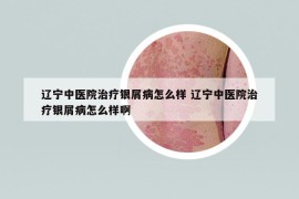 遼寧中醫(yī)院治療銀屑病怎么樣 遼寧中醫(yī)院治療銀屑病怎么樣啊